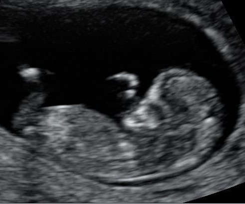 Echo baby 12 weken zwangerschap