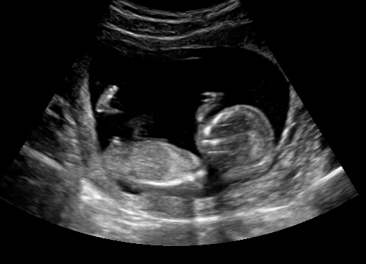 Echo baby 19 weken zwangerschap