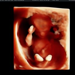 Echo baby 13 weken zwangerschap