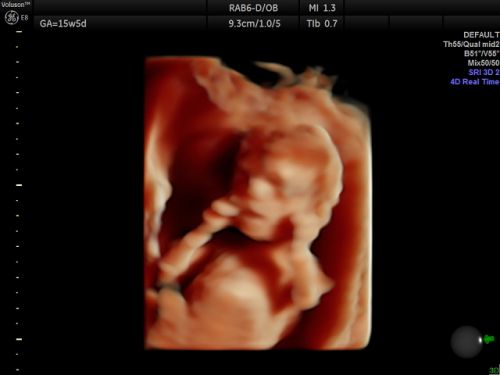 Echo baby 15 weken zwangerschap