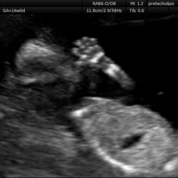 Echo baby 14 weken zwangerschap