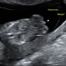 Echo baby 14 weken zwangerschap