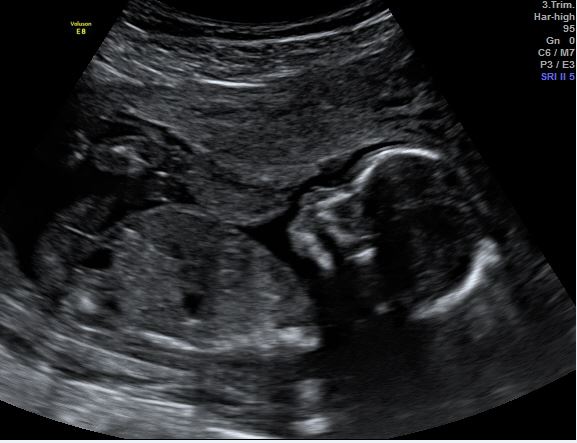 Echo baby 16 weken zwangerschap
